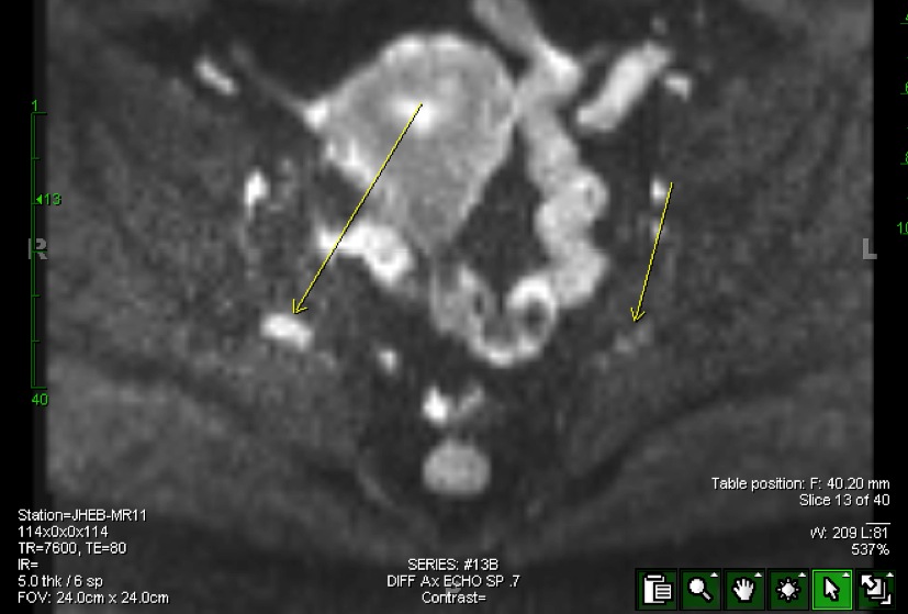 Figure 4 for case split right sciatic
